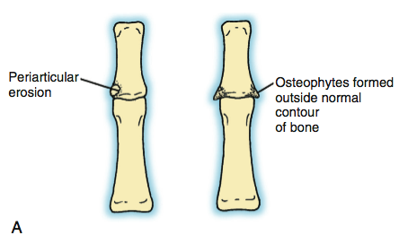 Arthritis of the Joints in the Finger Figure 1A