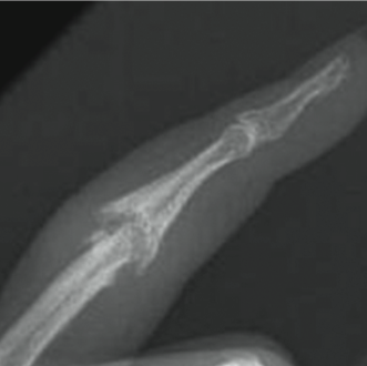 Arthritis of the Joints in the Finger Figure 2