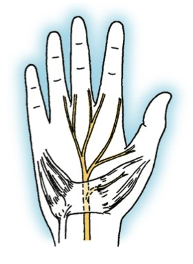 Carpal Tunnel Syndrome Figure 1