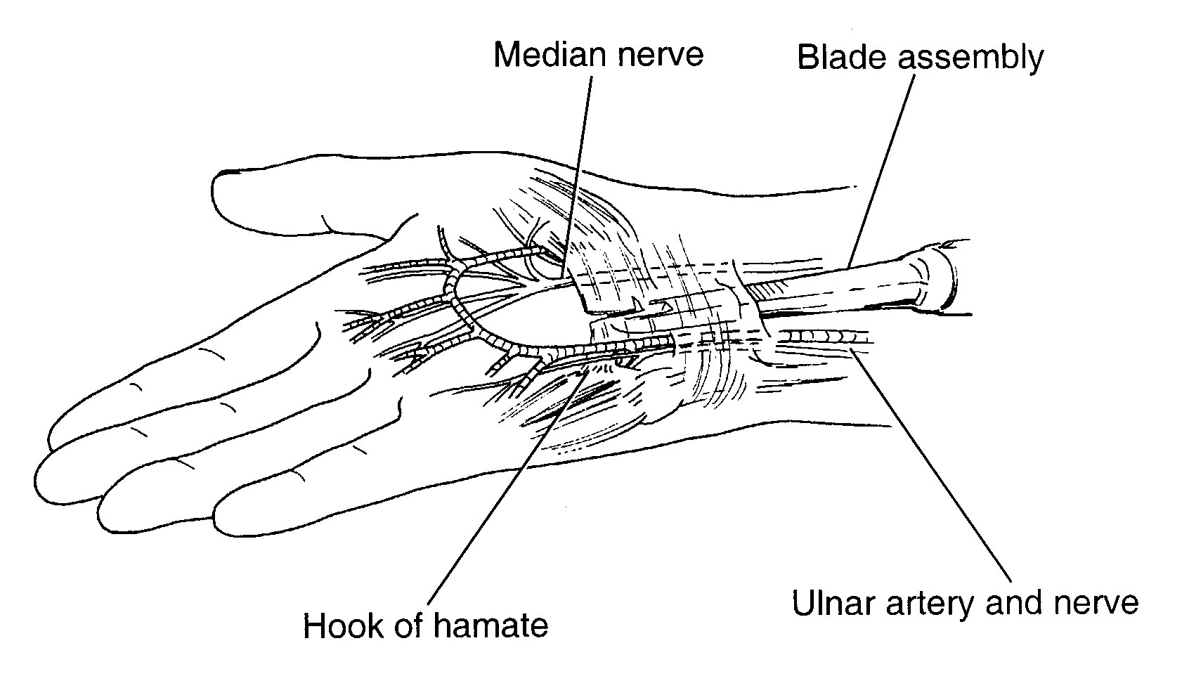 Carpal Tunnel Syndrome Figure 3